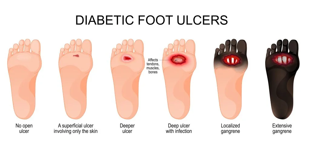 Stages of diabetic foot ulcers — from superficial ulcer to localized gangrene