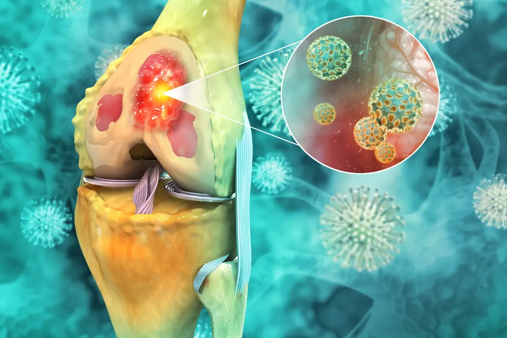 Imaging evaluation of a bone tumor at Anadolu Medical Center